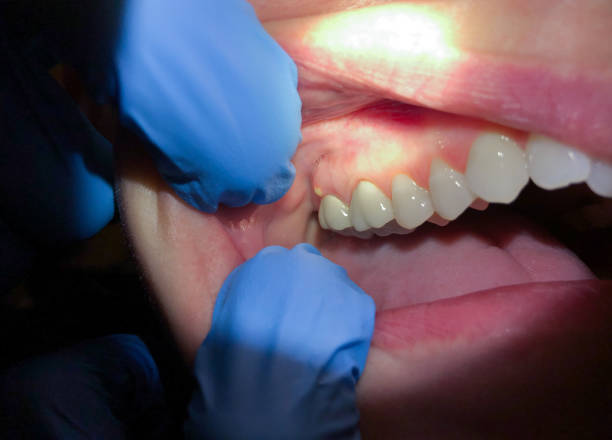 Best Emergency Dentist for Lost Fillings or Crowns in Castle Point, MO